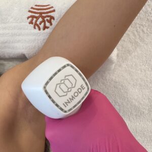 IEM SPA Laserová epilace - podpaží