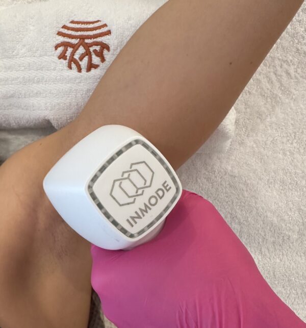 IEM SPA Laserová epilace - podpaží